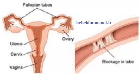 What are the symptoms of Fallopian Tube Obstruction.jpg
