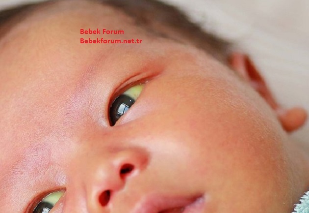 Yenidoğan Sarılığı Kaç Gün Sürer.jpg